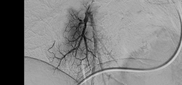 Визуализация сосудов на ангиографе