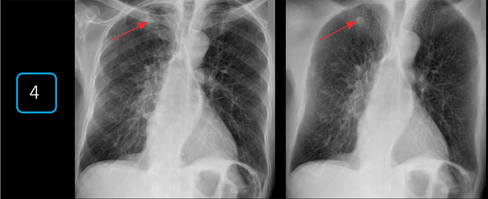 Рентгеновские снимки грудной клетки пациента