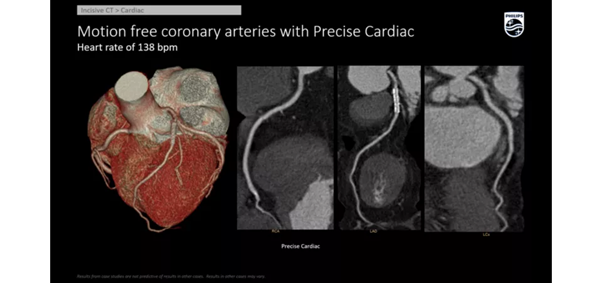 Фото сердца на компьютерном томографе