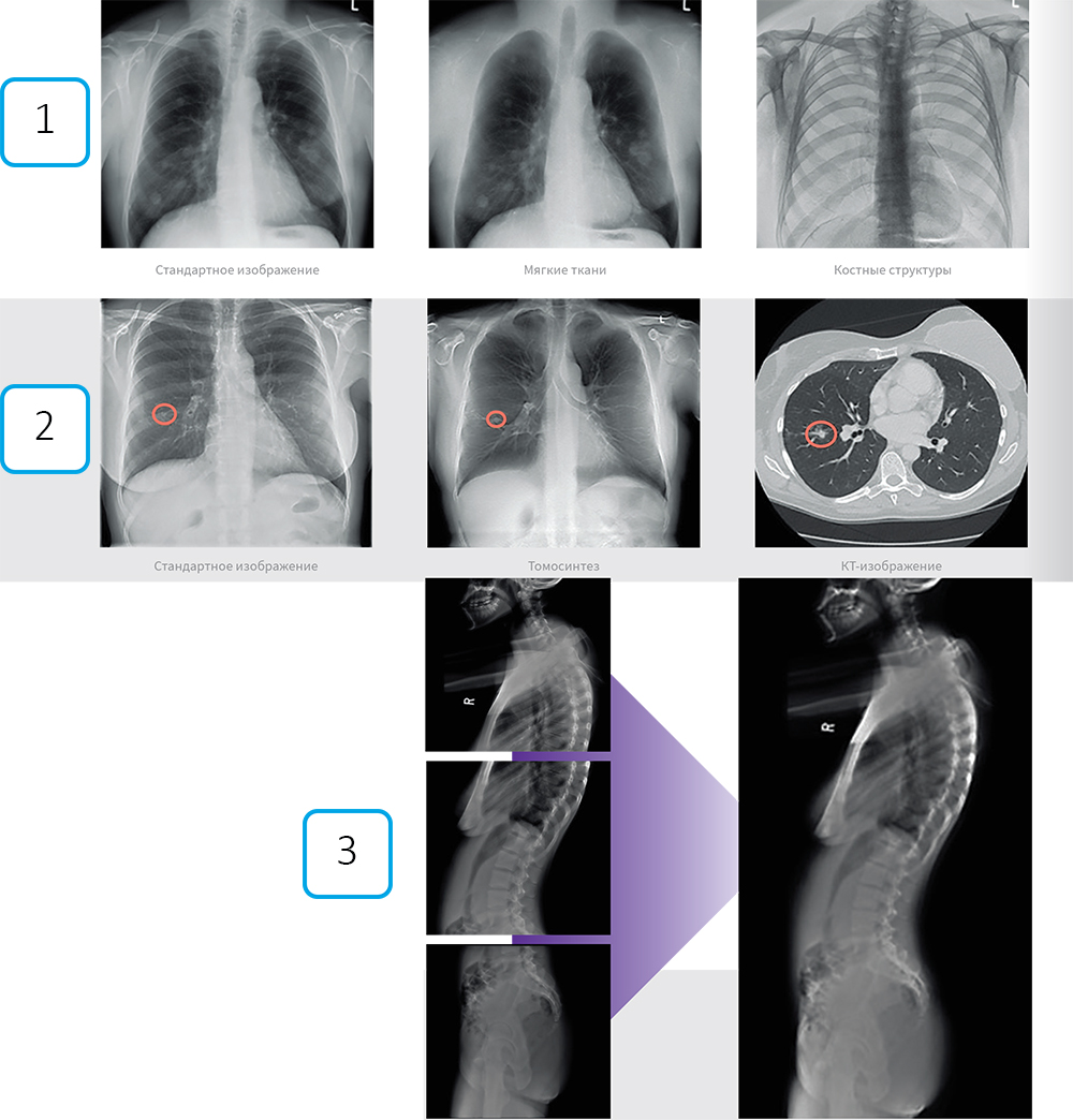 Рентгеновские снимки грудной клетки