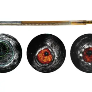 Reconnaissance PV .018 OTW — Цифровой катетер для ВСУЗИ